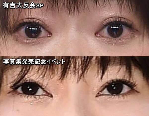 指原莉乃のICL手術報告とICL手術とは？さらにネットの声は・・・・