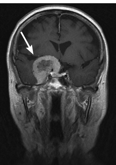 安田章大手術報告！渋谷すばるの記者会見欠席も明らかに