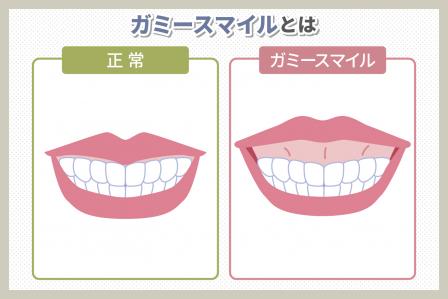 ガミースマイル